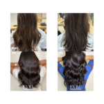 Kolageno procedūra - Image 2